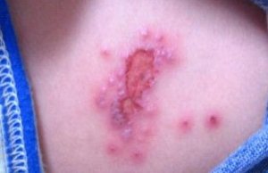 脓包疮的危害不可小视