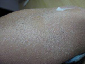 鱼鳞病的危害