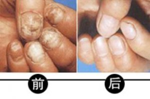 灰指甲怎么治疗最快