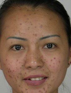 脸上有粉刺怎么办