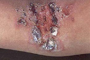 预防脓疱疮要注意什么